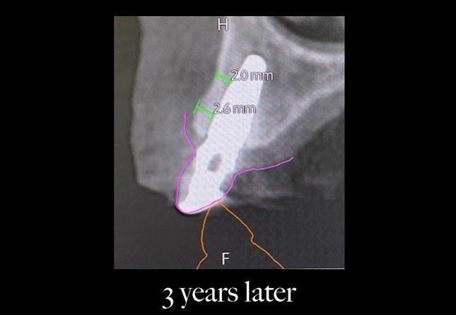 Implant planning always has a lot going on. One goal is to have sufficient thickness of bone on the front (facial) of the implant. Literature reviews show that 2mm is the new goal.

In this case a canine was removed with an implant planned. Canines a