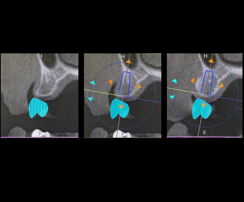Tooth loss often results in loss of bone that is too thin to support an implant. The jaw bone needs to be thick enough to place an implant.

The ridge was augmented with a minimally invasive surgery. After a few months of healing, the implant was pla