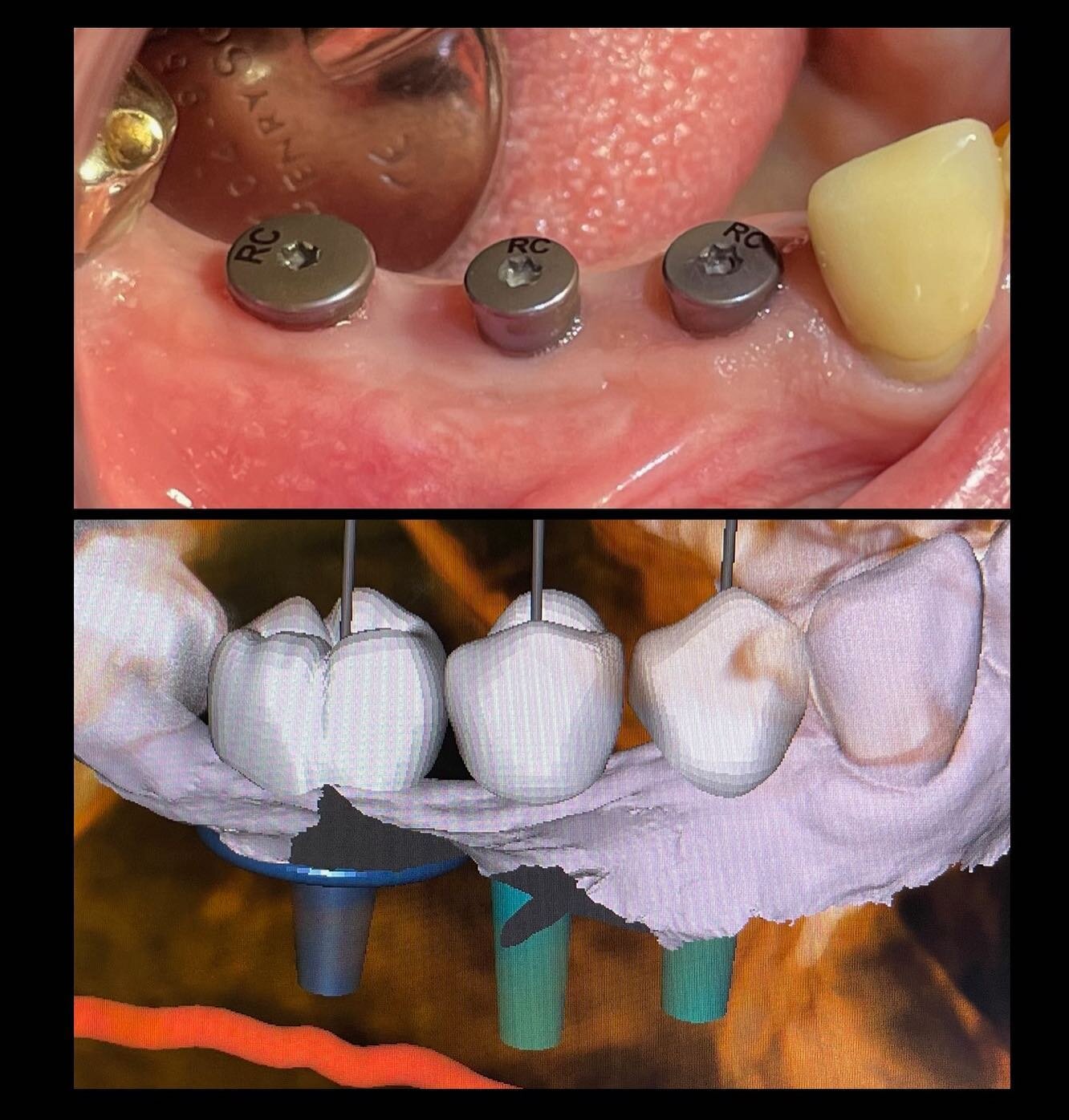 To know where you&rsquo;re going, it helps to have a plan.

Dental implant placement should be in a location based on the final plan.

The final plan includes the crowns (&lsquo;teeth&rsquo;) in a proper occlusion (&lsquo;bite&rsquo;) with implants u