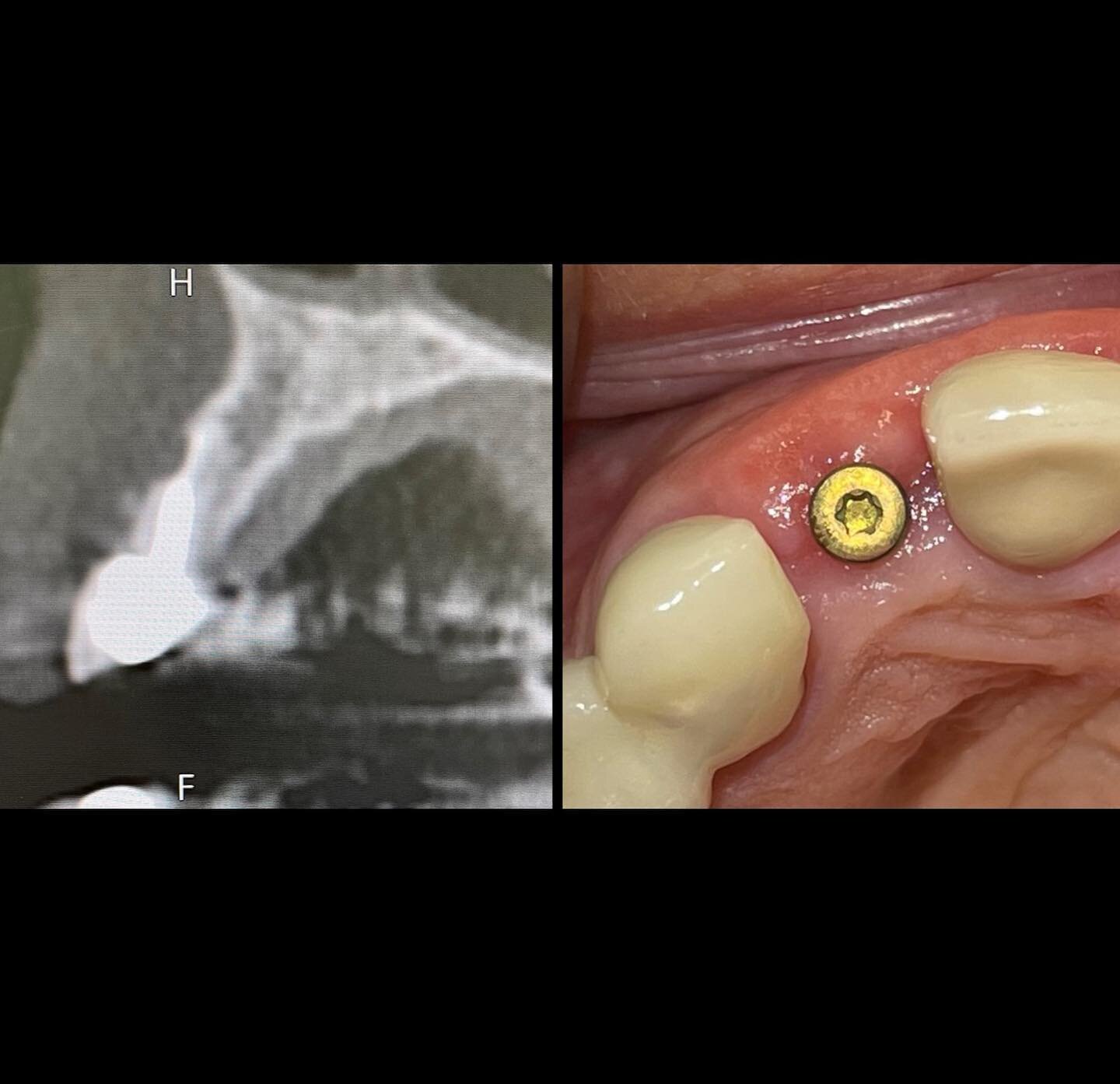 Start to finish of a failing lateral incisor replaced with a bone graft and dental implant. 

Tooth extraction causes loss of bone in the jaw (alveolar ridge).

Infection also often causes bone loss.

Lack of bone prevents implants placement in the r