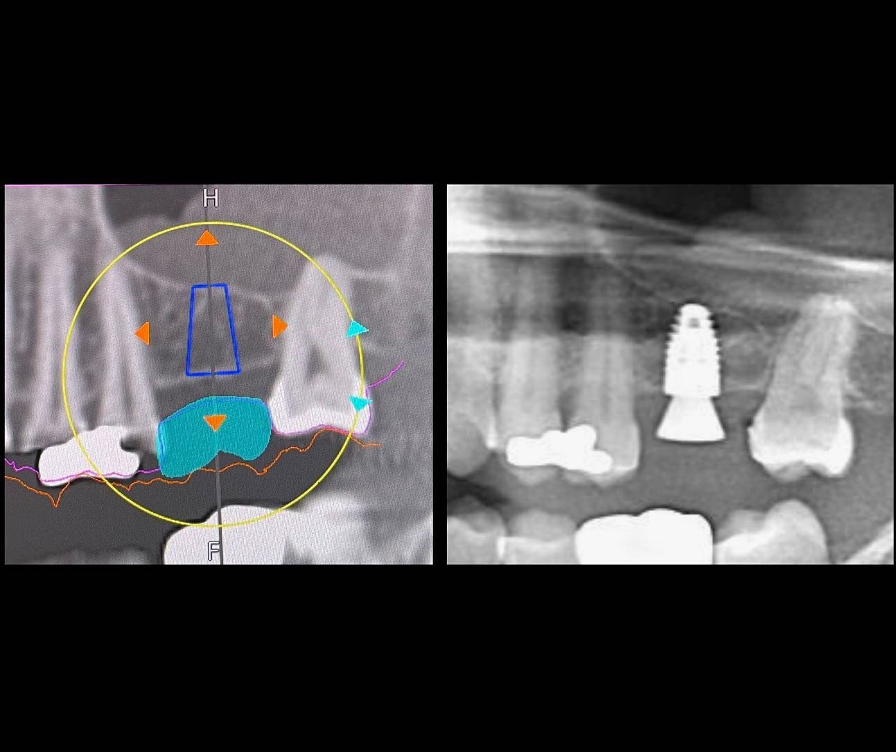 Planning with the end in mind gives best results.

This post shows virtual planning and final result of an implant to replace a maxillary first molar.

Software and guided surgery to help plan and execute treatment. 

A digital impression is taken as
