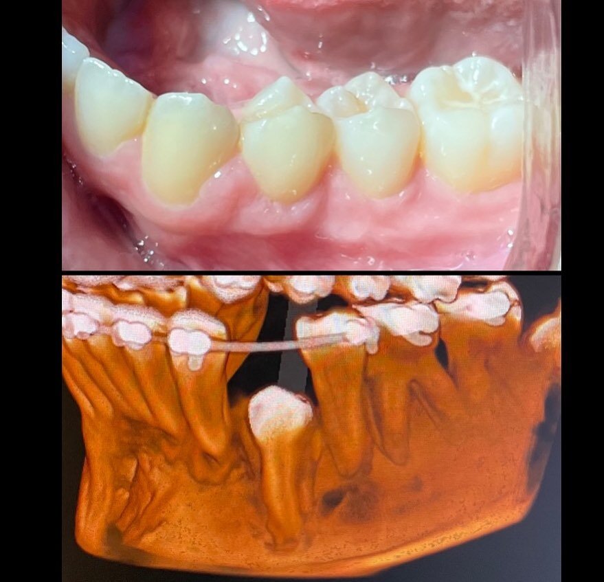 This is a case that made a difference in a young patient&rsquo;s smile.

A deeply impacted lower premolar was refusing to erupt into the mouth.

Oral surgery + orthodontics helped access, bond, and bring this tooth into the arch with the other teeth.