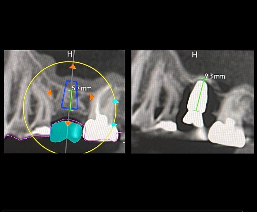This case shows a missing upper first molar being replaced with an implant. After the extraction and graft healed, there was good width but less than 6mm of bone height. My goal in this case was to place an 8mm tall implant.

During implant placement