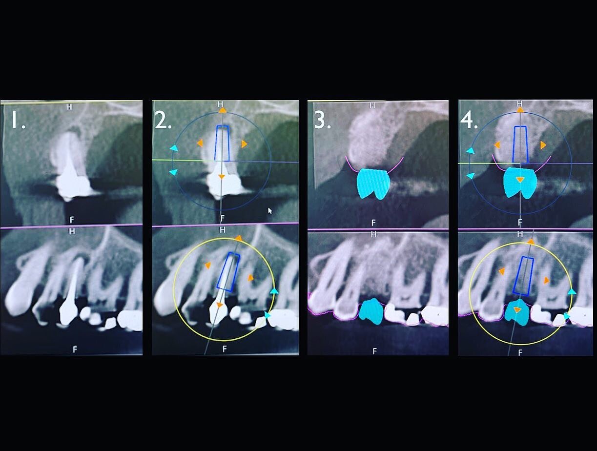 1.	A tooth was infected and needed removed. It had been treated with a root canal but infection persisted. The patient wanted it replaced with an implant.

	2.	3D planning showed where a future virtual implant should be placed. It also helped to eval