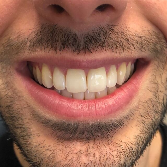 Our passion and dedication is making beautiful smiles happen. With only 4 months of Invisalign treatment, this patient achieved having a perfect smile. #dentistry #dentistrylife #encinodentist #cosmeticdentistry #invisalignsmile #invisalign #dentalof