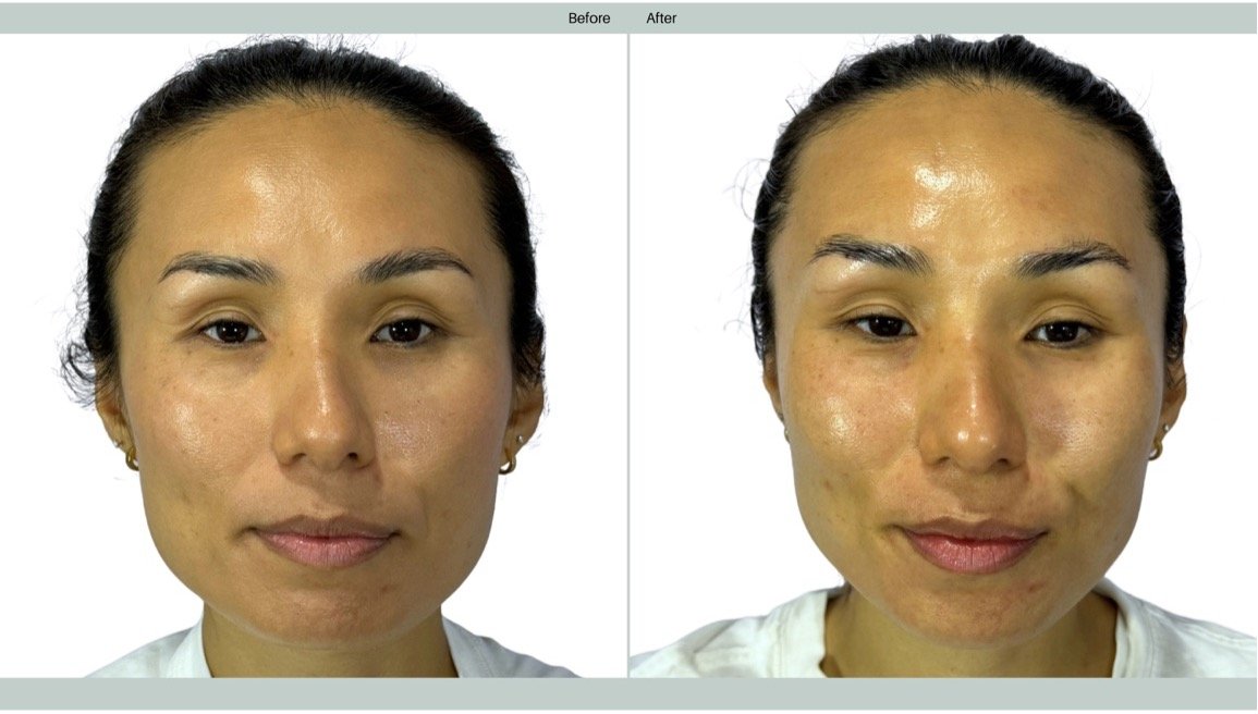 Before and after results of EMFACE® lifting the cheeks and smoothing forehead wrinkles.