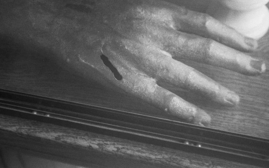 Hou Lam Tsui: Trichiasis at HART HAUS