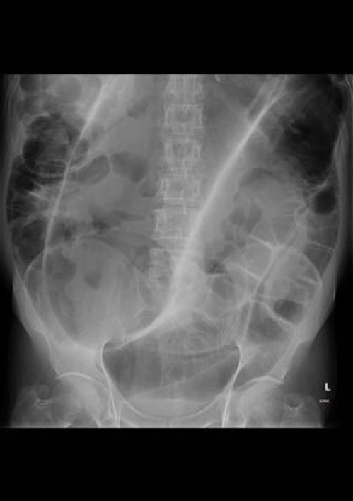 Figure 1: Sigmoid volvulus, The inverted U or “Omega Loop” or “Coffee bean sign”