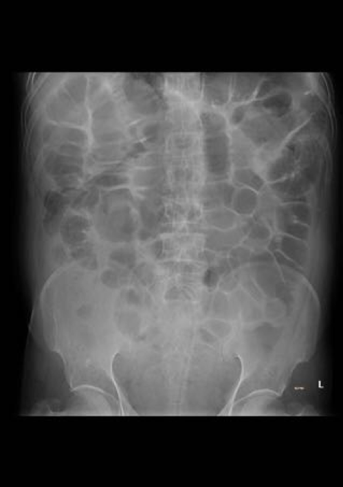 Figure 2 : Post decompression and insertion of rectal tube of same patient.