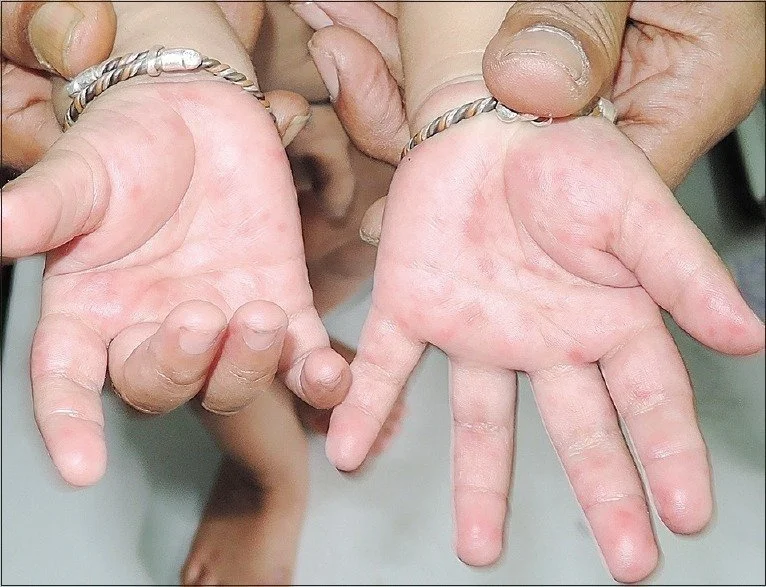 Hand, Foot, and Mouth Disease in Children