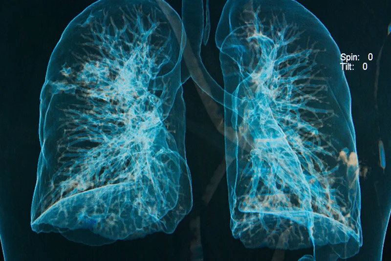 ENFERMEDADES PULMONARES OBSTRUCTIVA CRÓNICAS