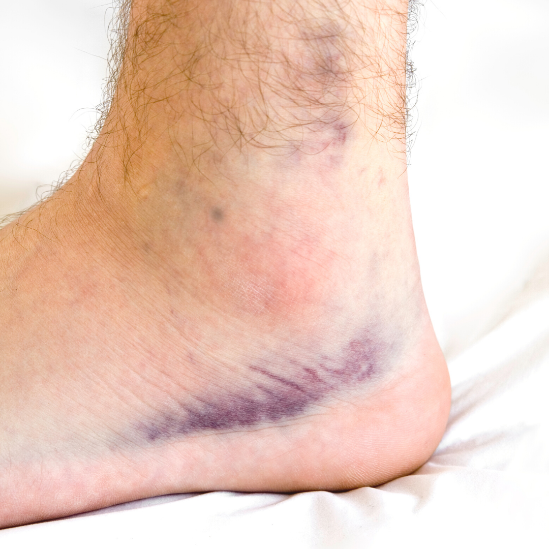 Signs and Treatment for Sprained Ankles