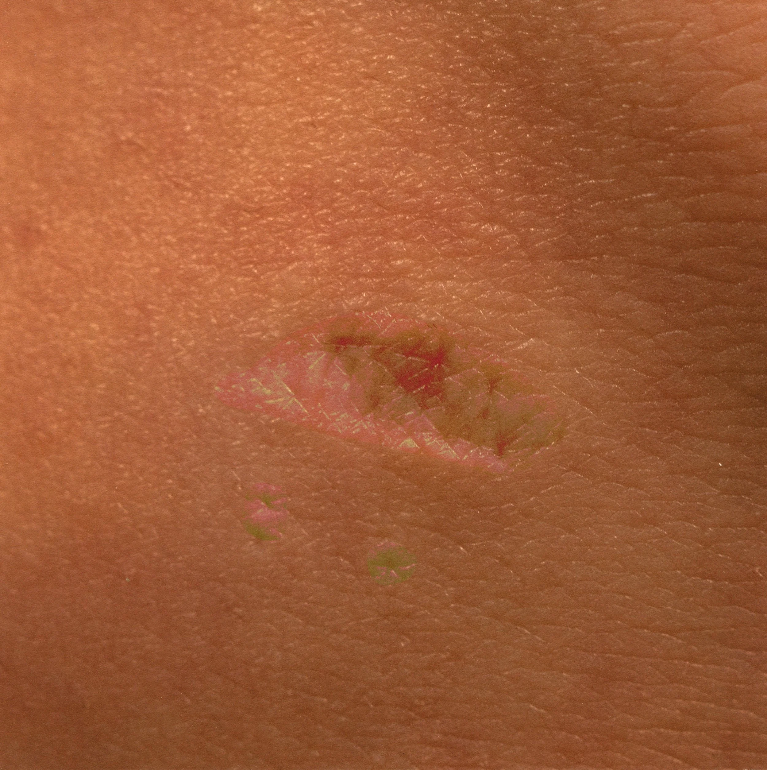 10. Meniscus repair, june 2023.jpg