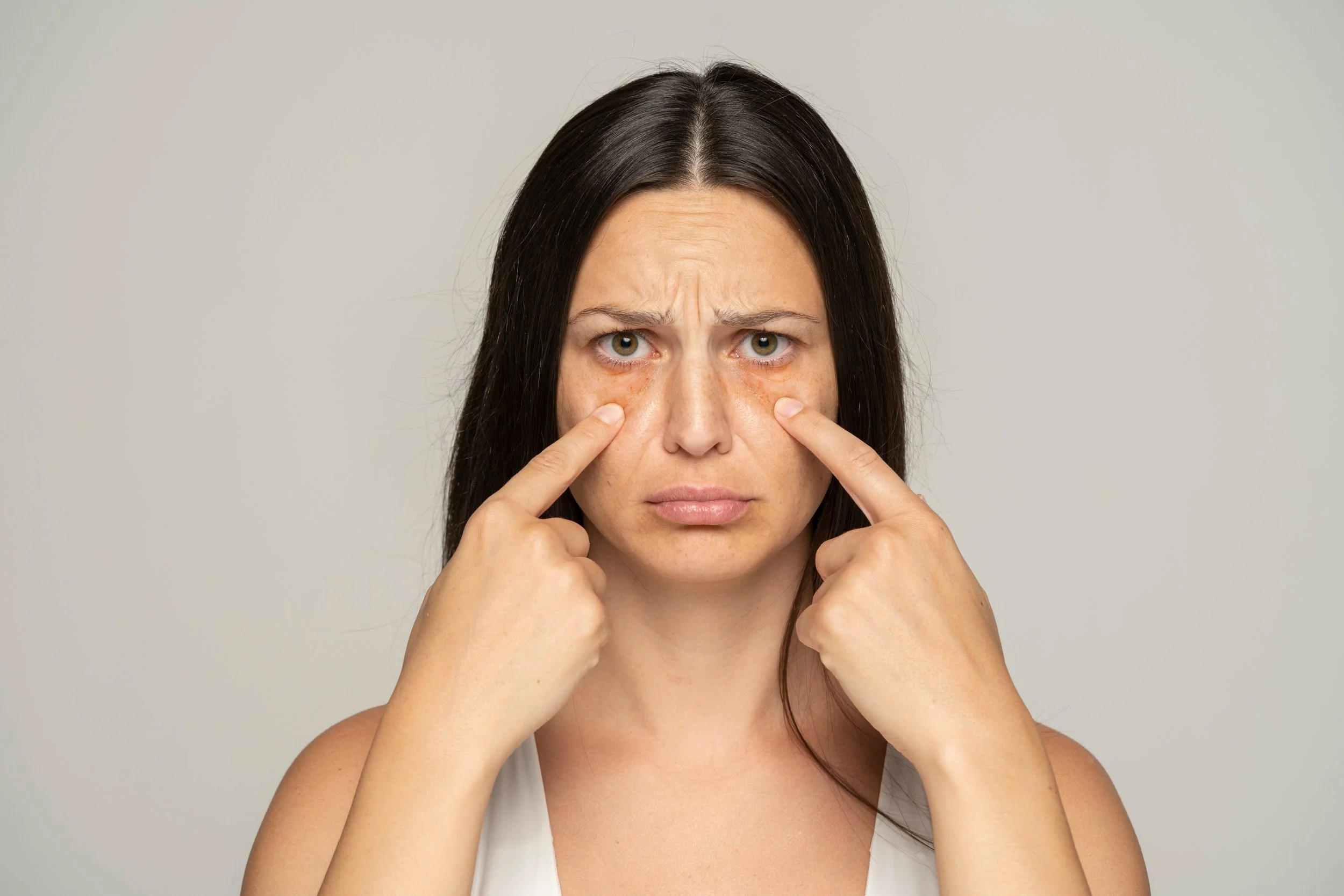 Are Dark Eye Circles A Sign Of Health Issues?