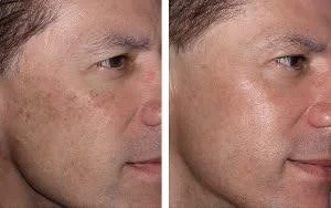 Why hydrafacial is the fastest way to hydrate a dry face?