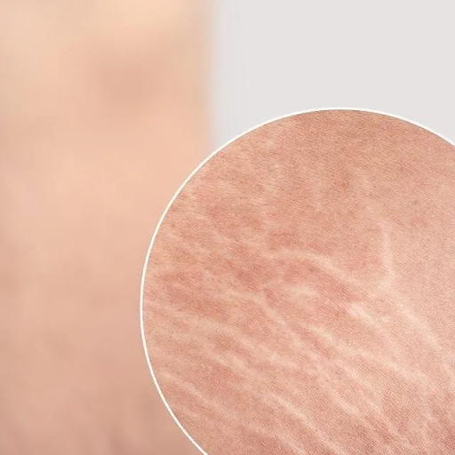 Stretch Mark Revision Without Color: What Clients Should Know Before Treatment