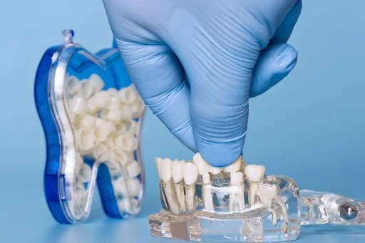 Dental Crowns: A Simple Guide to Protecting and Restoring Your Teeth