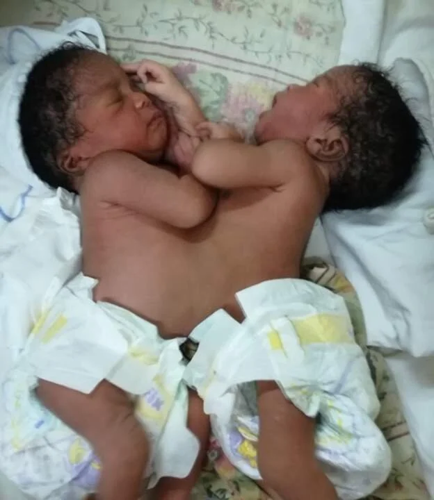 Nigerian doctors successfully separate conjoined twins