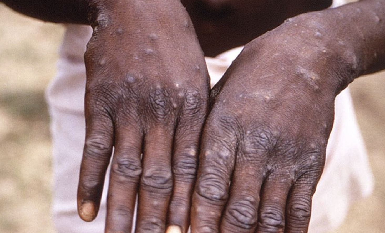 Nigeria Records Fresh 41 Cases of Monkeypox in 7 Days