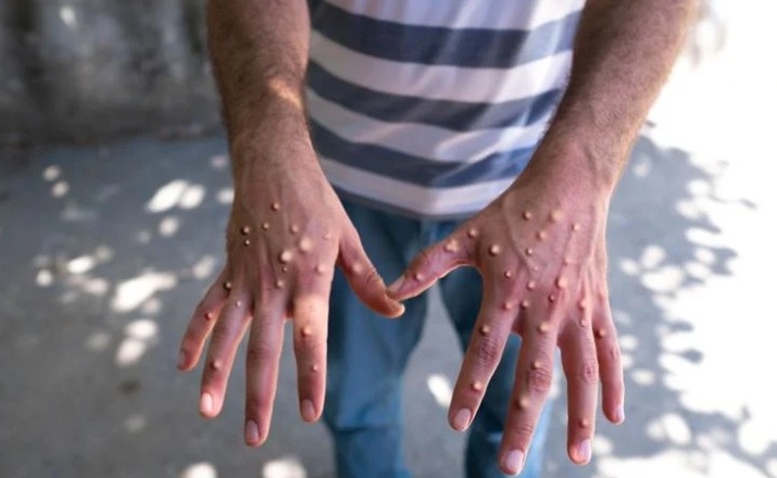 Mpox Cases Spike In Liberia