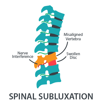 What is Subluxation?