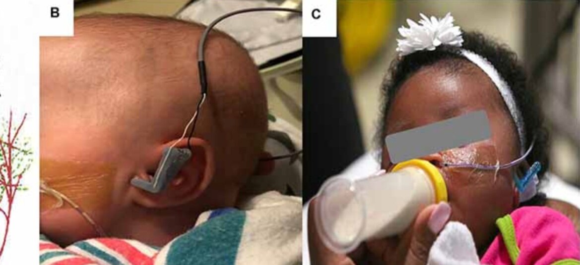 New paper: Vagus Stimulation Rehabilitation for Feeding Problems in Newborns: