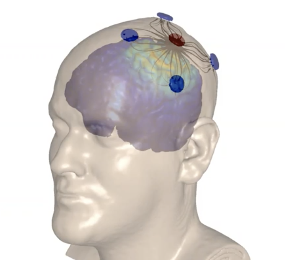 HD-tACS (invented at CCNY Neural Engineering) shows to boost memory in adults (NBC, BBC, Nature...)