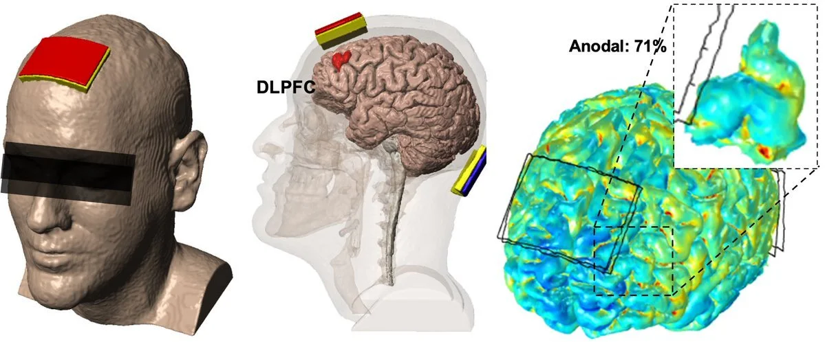 New paper:  TDCS Slows Cognitive Decline