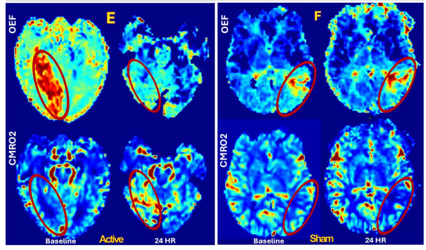 New paper: Cathodal HD-tDCS of of Ischemic Tissue