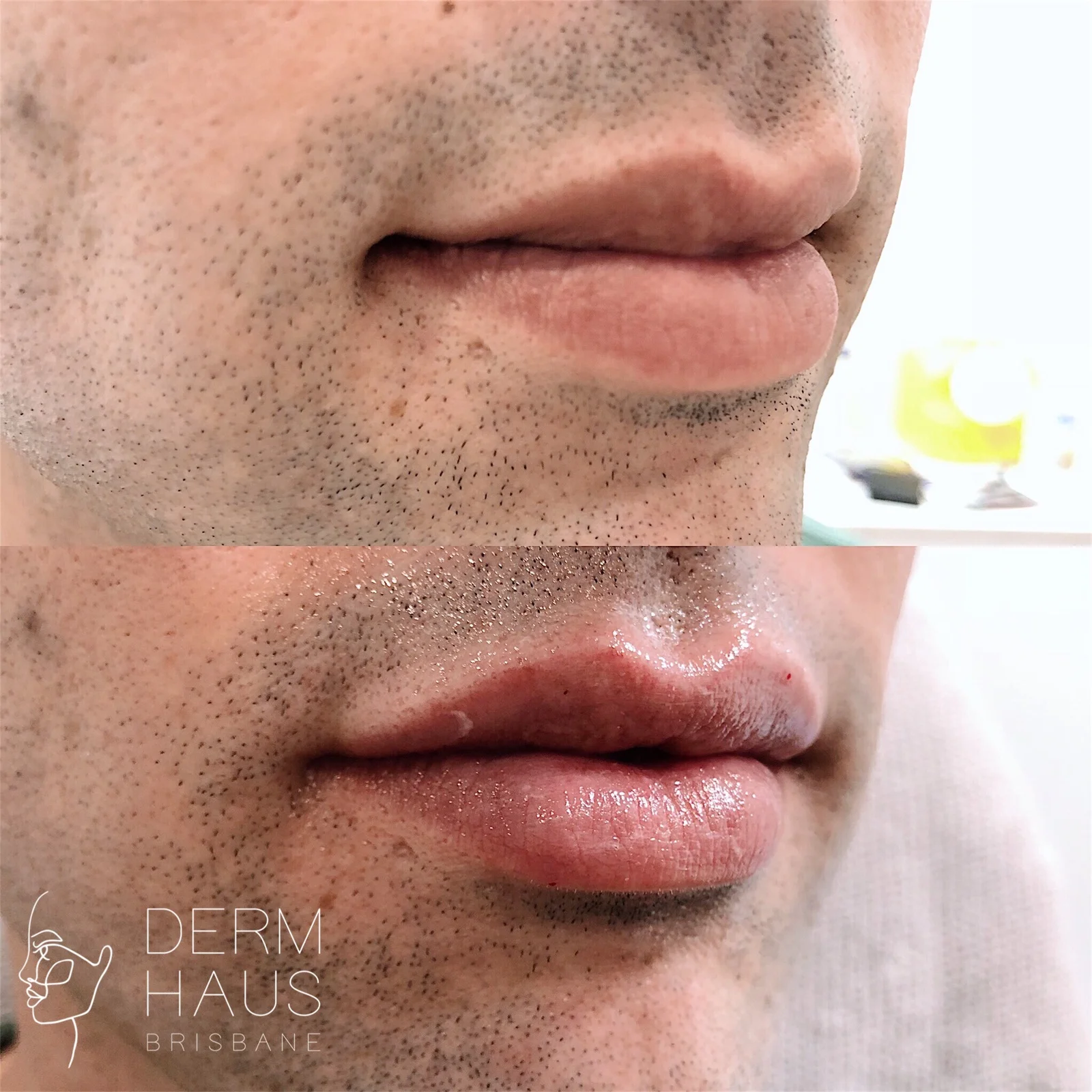 Affordable Dermal Filler Expert Cosmetic Injectors Brisbane