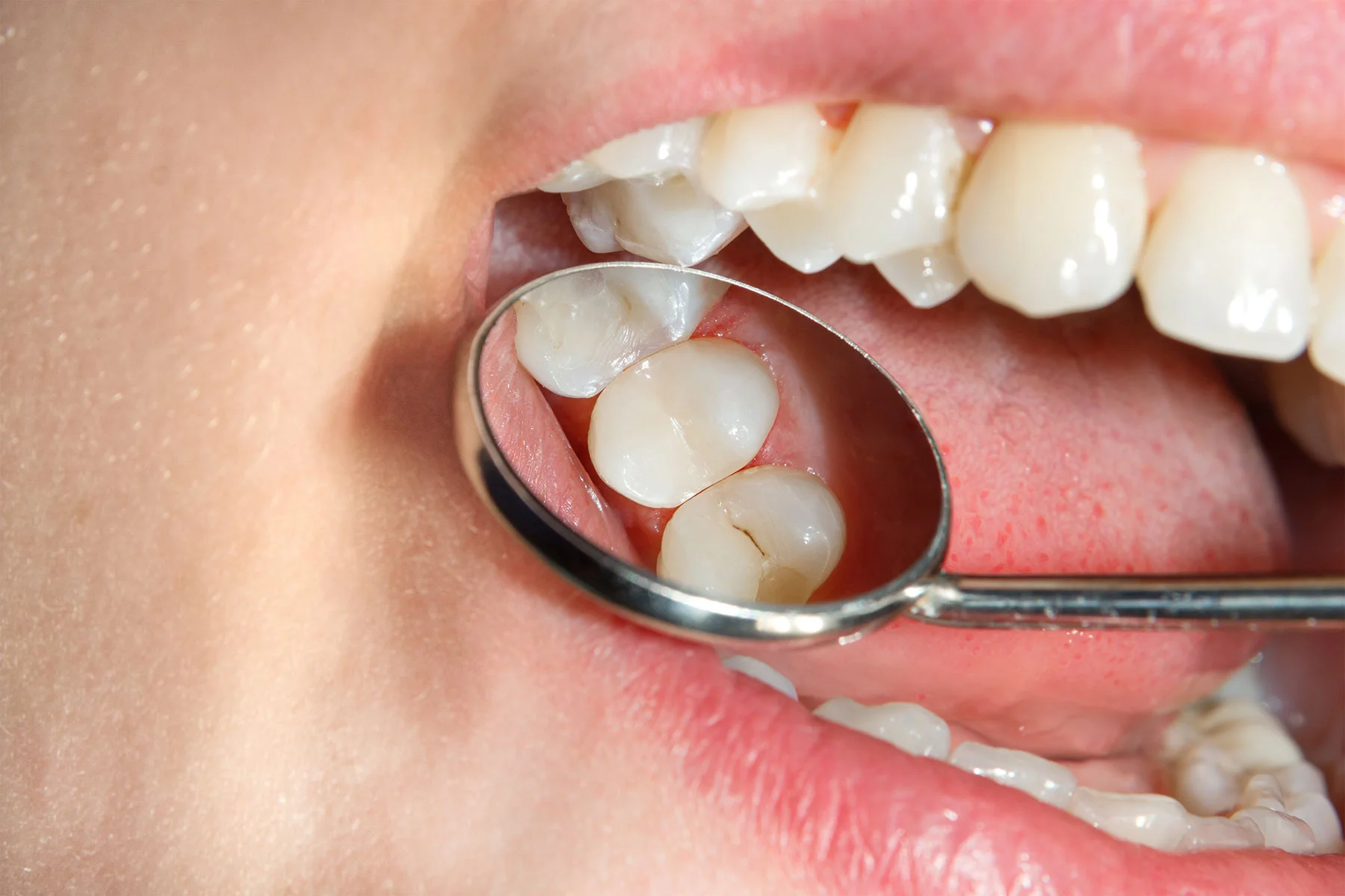 dental-sealants.jpg