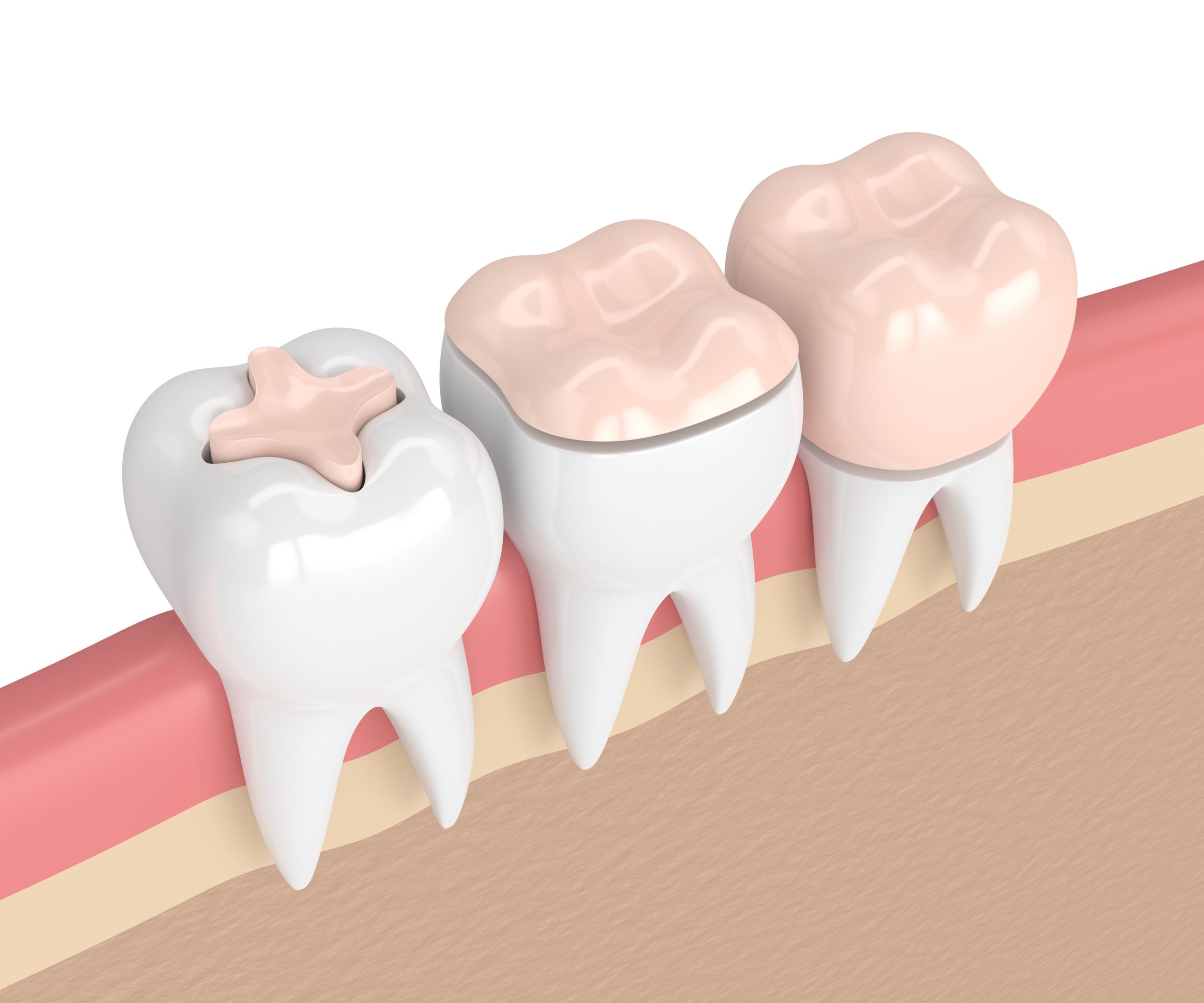 Dental-crown-treatment.jpeg