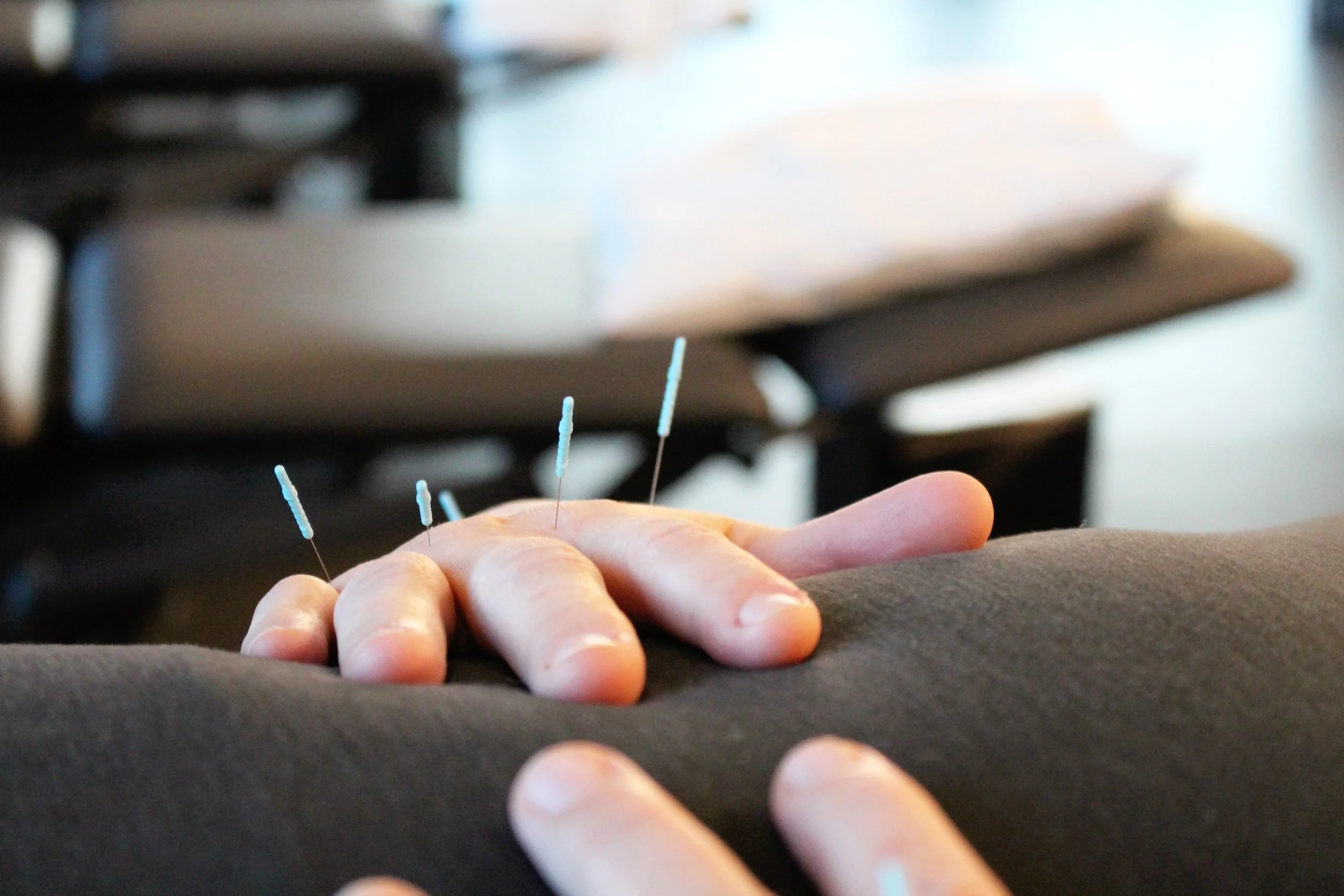 Dry Needling and Acupuncture Edmonton — Pursuit of Motion