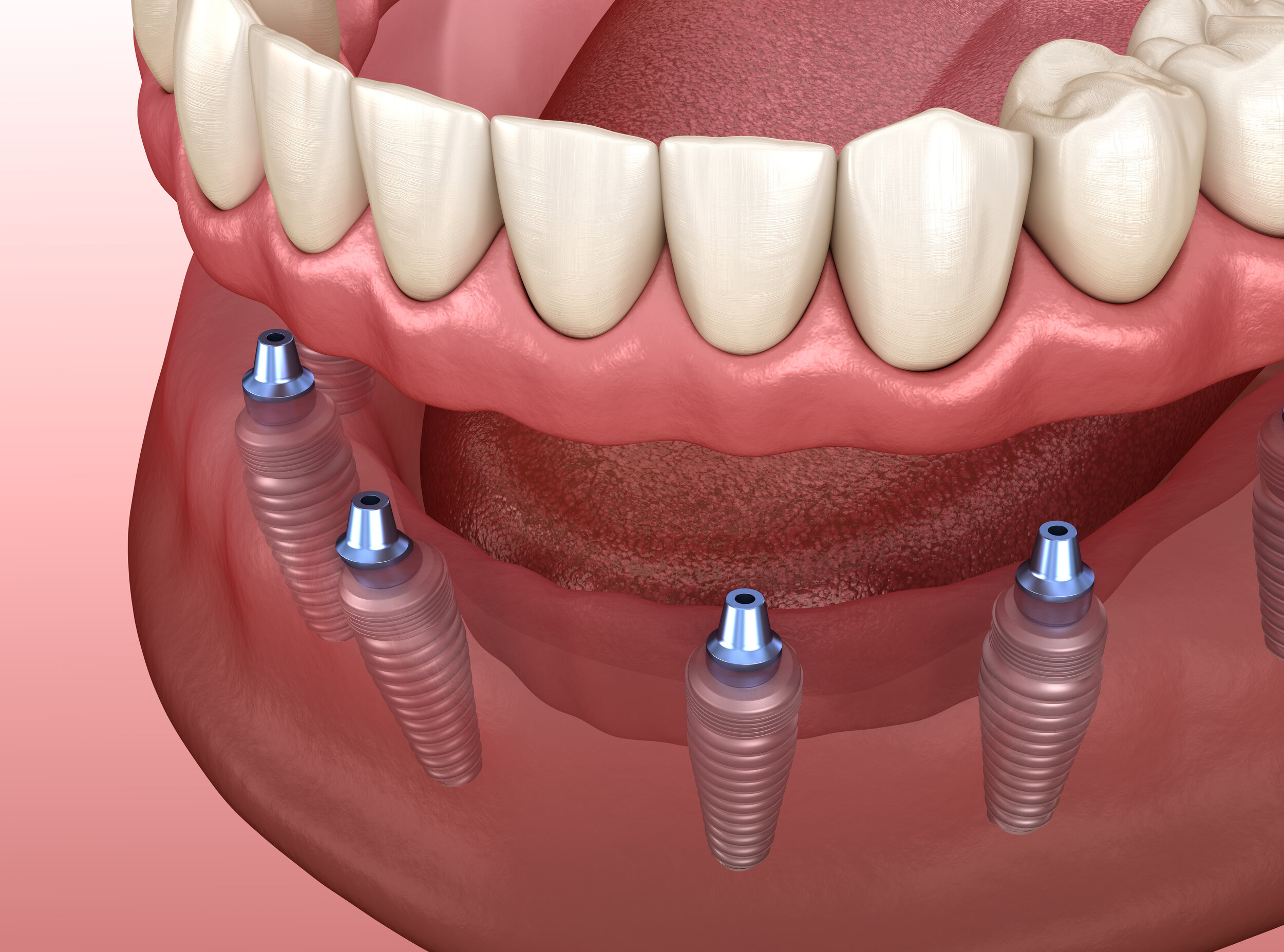 Natural, Functional and Comfortable Full Mouth Teeth Replacement Options