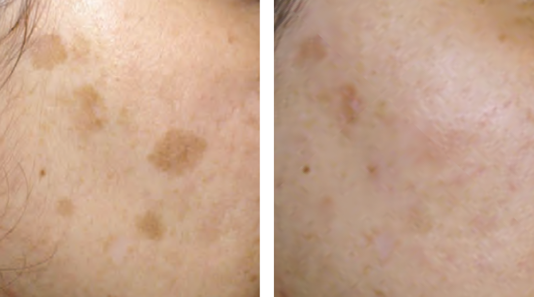 Laser Hair Removal Ipl Photofacials Wrinkles Acne Scars Sun Spots Age Spots Skincare Treatments Renewal Laser