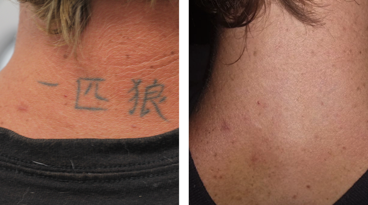 12 Factors that Affect Laser Tattoo Removal  FADE