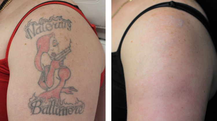 201 Laser Tattoo Removal Photos and Premium High Res Pictures  Getty Images