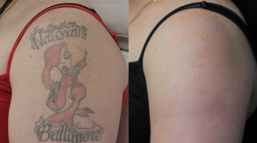 Tattoo Removal in North Myrtle Beach  Touch MedSpa