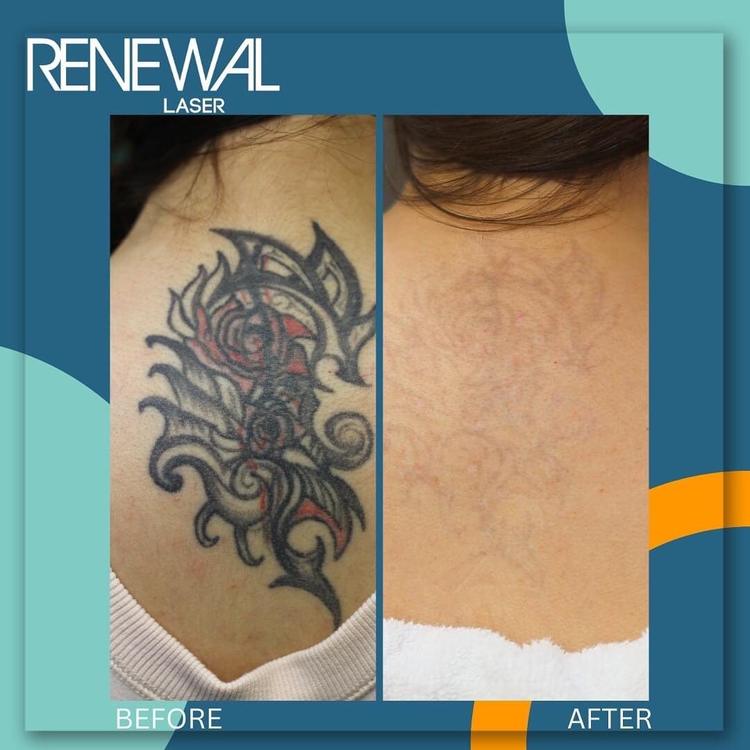 Some tattoos need above average number of treatments like this one.  20 sessions on this back piece. The average tattoo needs about 10 laser sessions. Some more and some less.  Factors that determine how quickly a tattoo is removed include ink color,