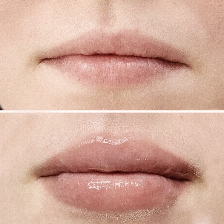 Small tiny bumps on lips