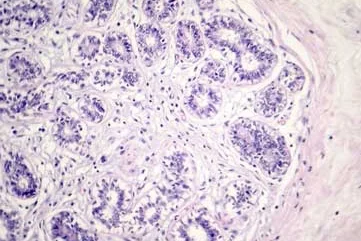 breast-cancer-cells.jpg
