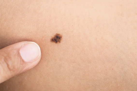 Skin Cancer Treatment Sydney Dermatologist Northern Sydney Dermatology Laser Sydney North Shore Dermatologist