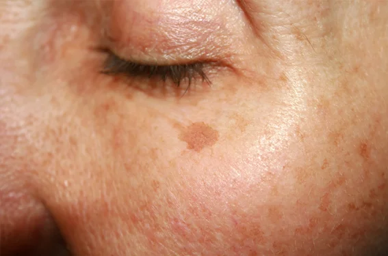 dermatologist for pigmentation near me
