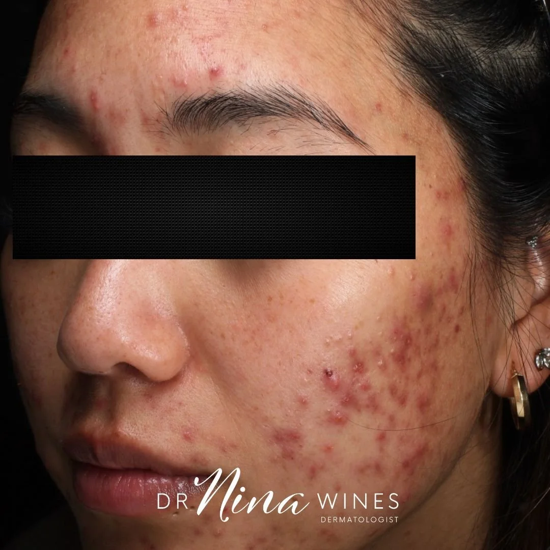 Acne Scarring — Northern Sydney Dermatology & Laser Sydney North Shore Dermatologist