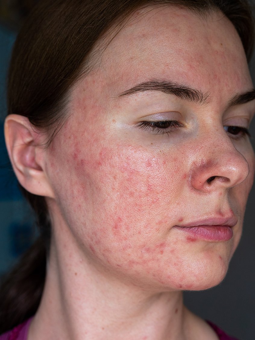 Rosacea Treatment Sydney Dermatologist — Northern Sydney Dermatology