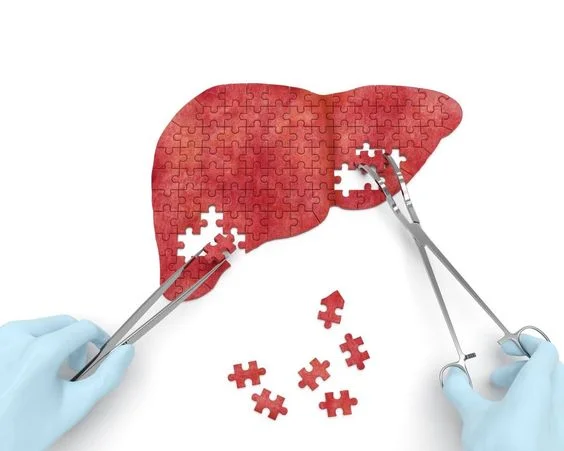 Silent Epidemic: Non-alcoholic Fatty Liver and 3 ways to prevent it.