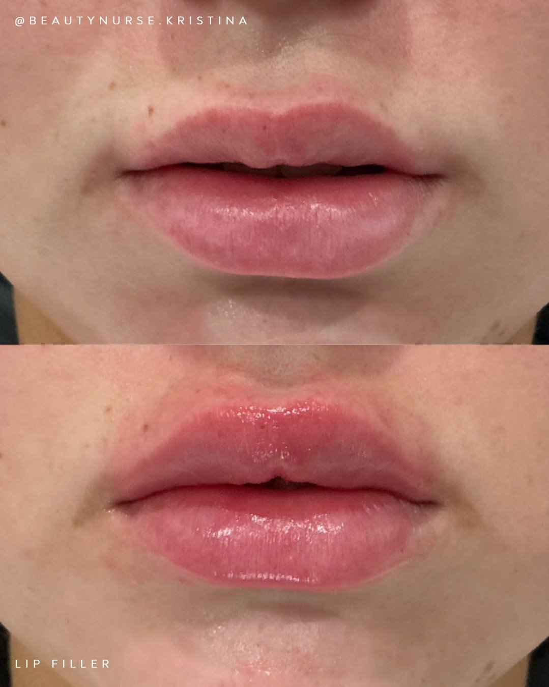 Pucker up! Valentine's Day is just around the corner. Get your lips date-night ready with lip fillers! This cosmetic, minimally invasive treatment will give you immediate results! Making your lips fuller, smoother, and perfectly kissable.

You can tr
