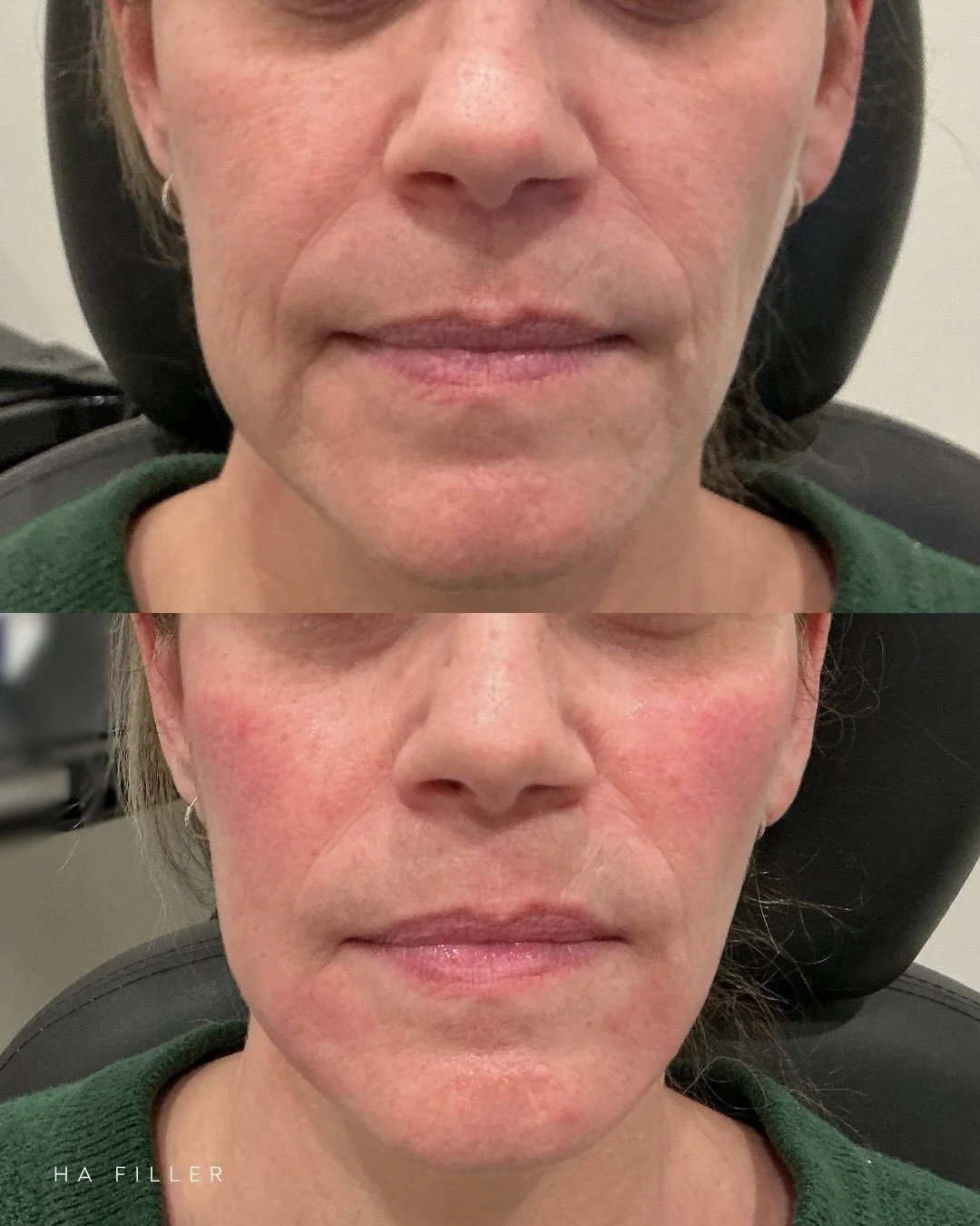 Restored structure. Refined balance. ✨ 

Before and after HA dermal filler to the cheeks and marionette lines with Nurse Kristina 🤍 @beautynurse.kristina 

Strategic placement helps restore mid-face support, soften marionette lines, and create a smo