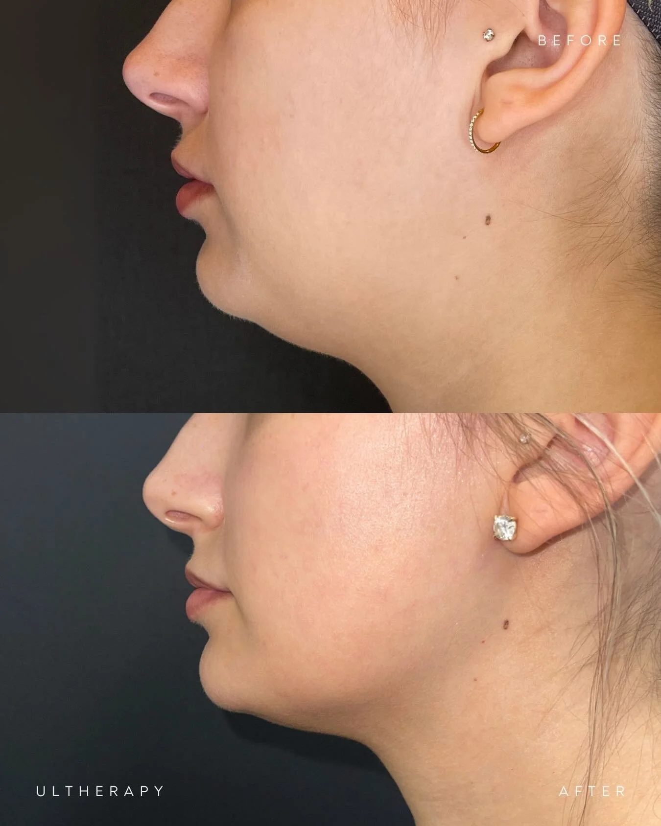 SNATCHED.

Real patients. Real results. ✔️

Ultherapy uses focused ultrasound energy to stimulate collagen production deep within the skin. It targets the foundational layers responsible for firmness and support of the face. 

The result? A gradual l
