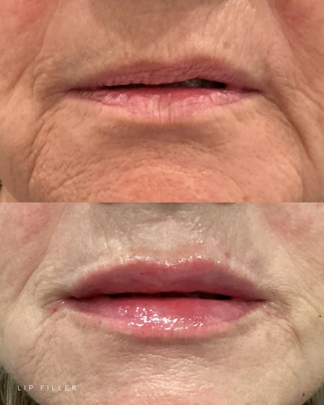It might be April Fools today&hellip; but this transformation isn&rsquo;t a joke 💋

Expertly sculpted lips that restore youth and confidence.

Turn back the clock and look years younger with results so natural, everyone will be fooled. 😉 

&mdash;&